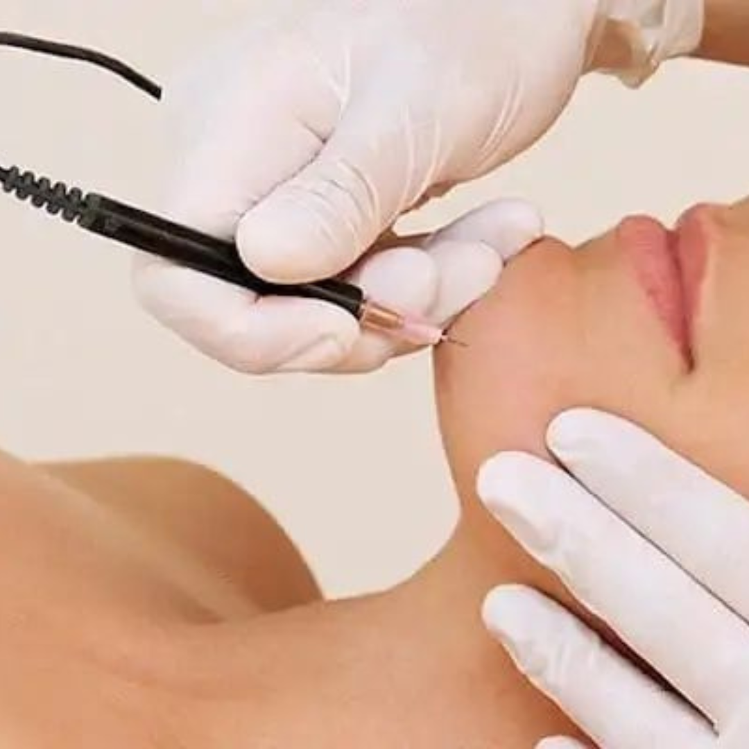 Electrolysis Treatment